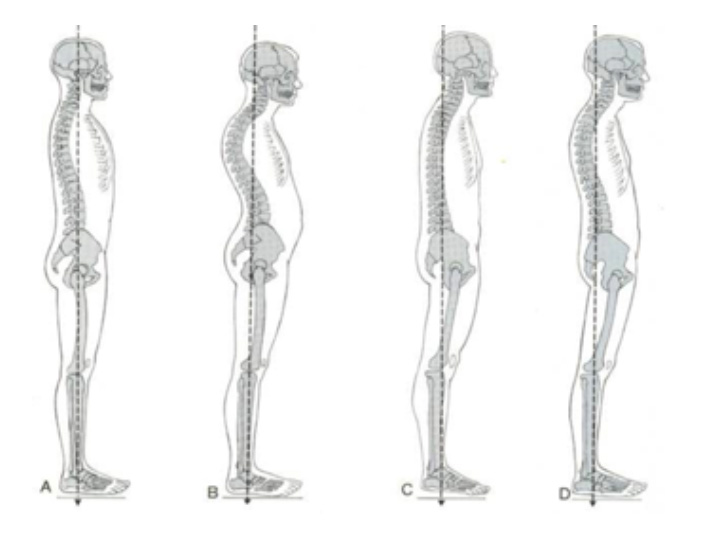  Types of Postural Imbalance