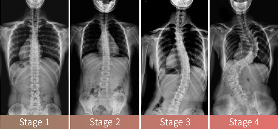 Stage of Scoliosis