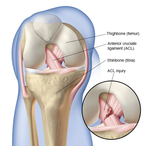 knee cruciate ligament rupture