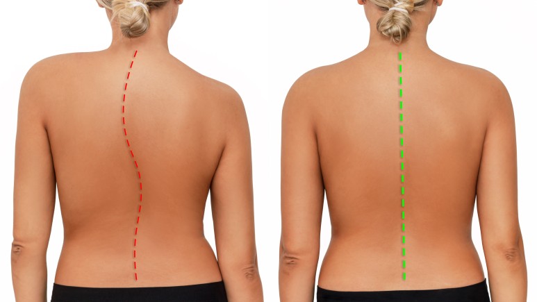 Thoracic Scoliosis back view