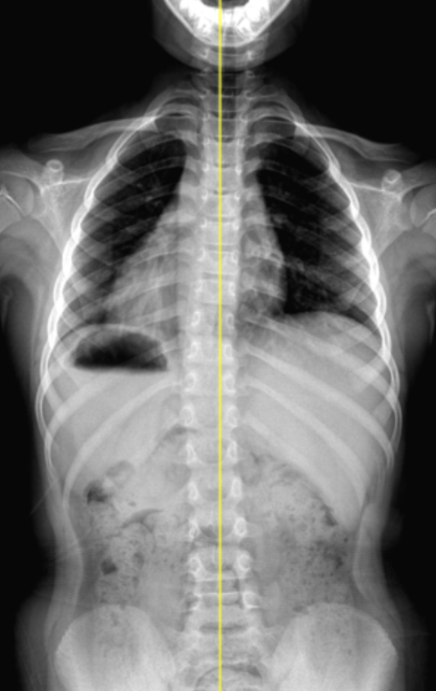 Scoliosis