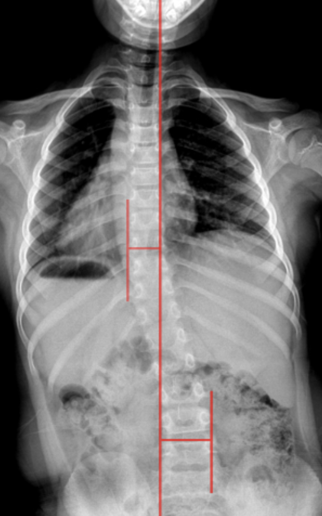 Scoliosis