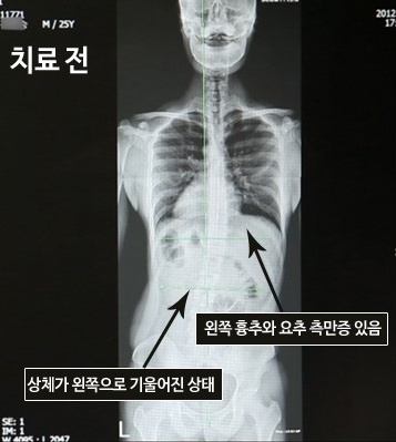 Scoliosis caused by pelvic distortion