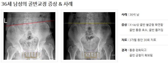 Pelvic correction