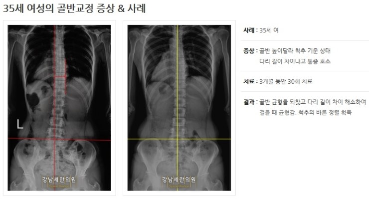 Pelvic correction