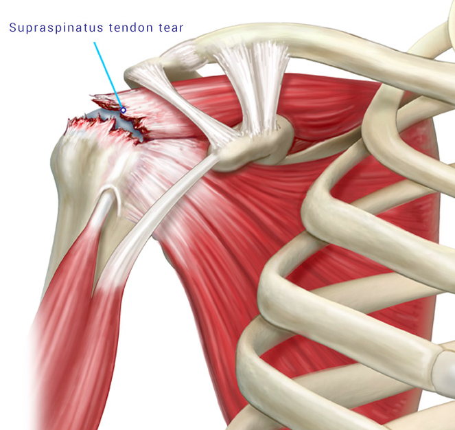 supraspinatus tendon tear