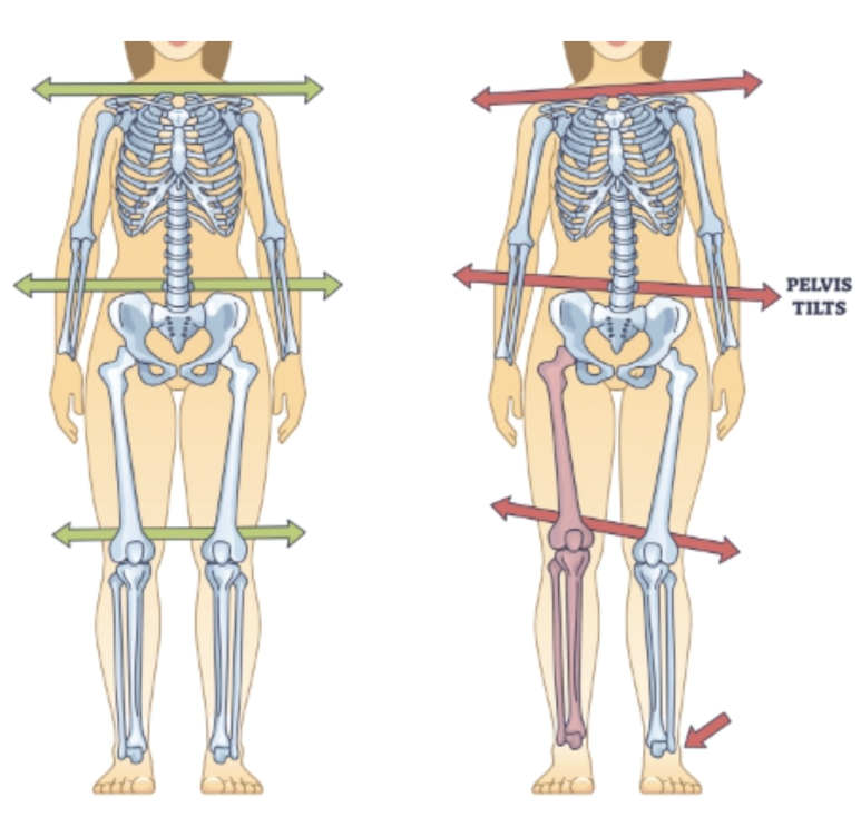 Pelvic tilt (Pelvic Imbalance)