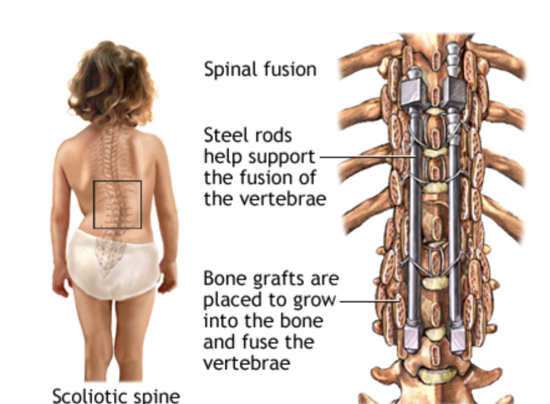 Surgery of Scoliosis