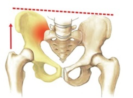 distorted pelvis