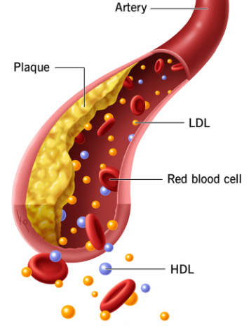 hyperlipidemia