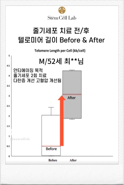 Impact of Stem Cell Treatment on Telomere Length