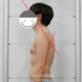 management of Round Shoulder Syndrome - before