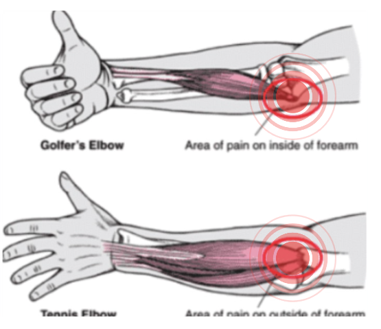 golf elbow & Tennis Elbow