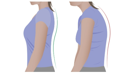 Round Shoulder Syndrome