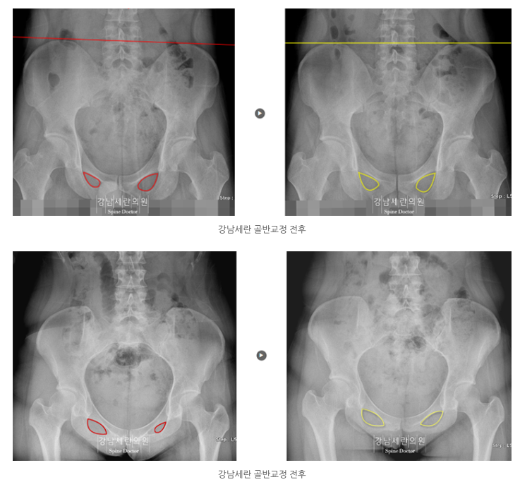 Before & after of Pelvic Alignment  Treatment