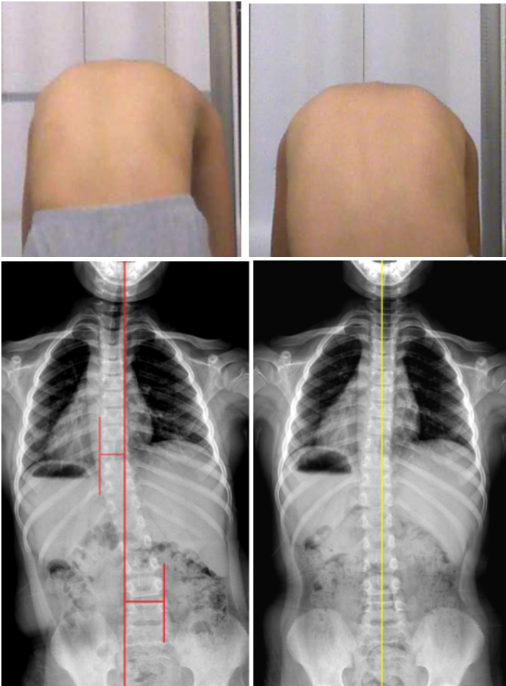 Before & After Scoliosis Treatment