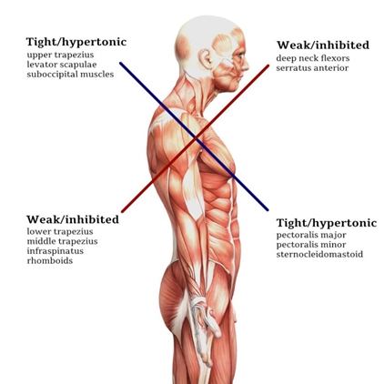 Round Shoulder Syndrome