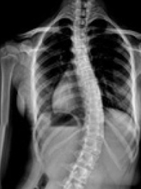 scoliosis