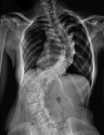 scoliosis