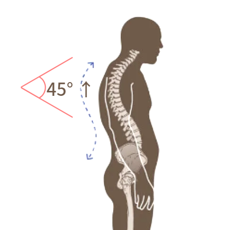 Kyphosis