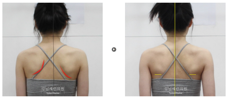 Scapular alignment after manual therapy and exercise therapy