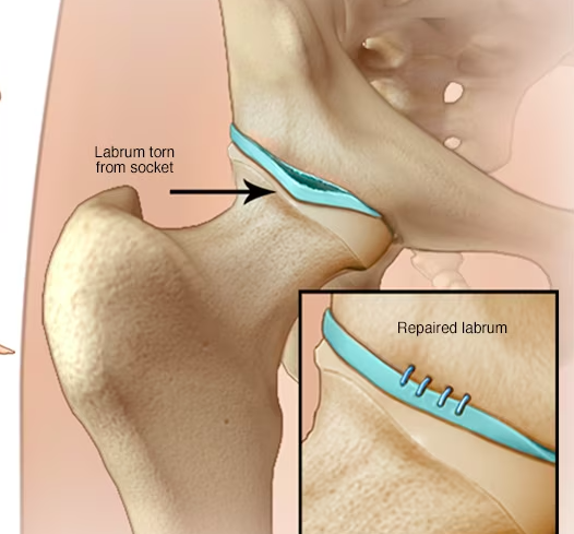 hip labrum tear