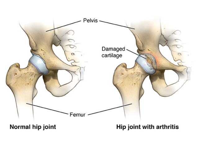 Hip joint with arthritis