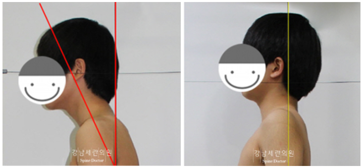 Straight neck, turtle neck, round shoulder correction before and after