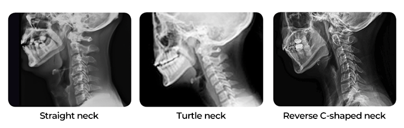 neck pain