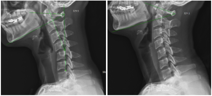 Before and after Reverse C-shaped neck