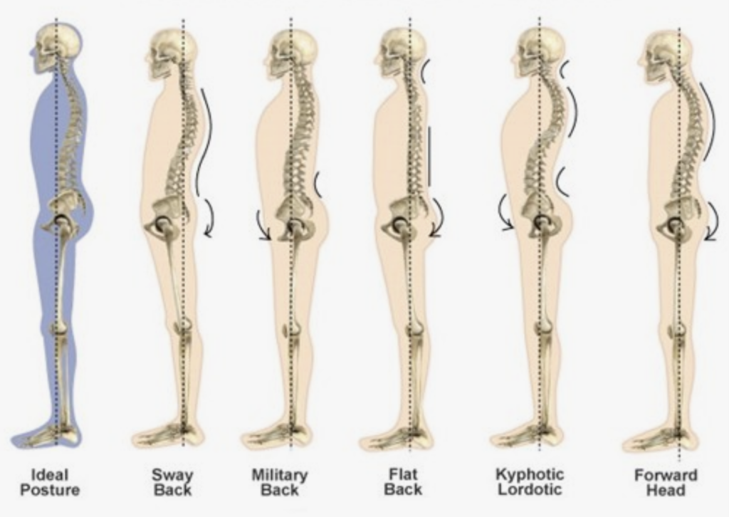 Postural imbalance