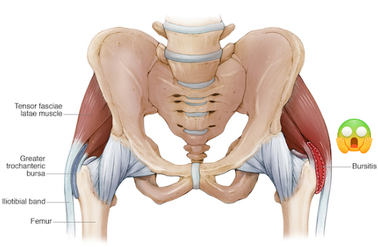 Bursitis