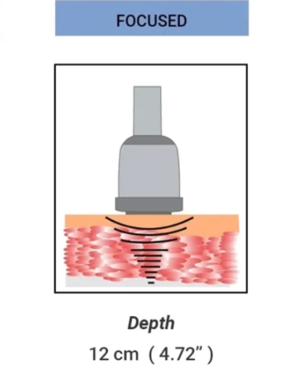 Focused Shock Wave