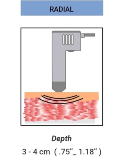 Radial Shock Wave