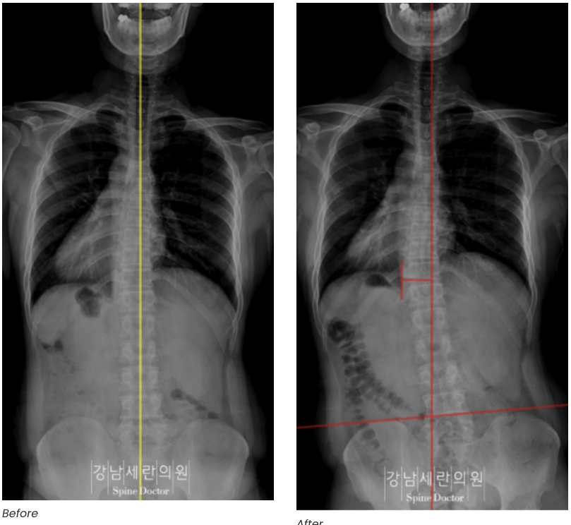 Scoliosis Treatment Before&after