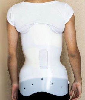 Scoliosis Treatment - Bracing