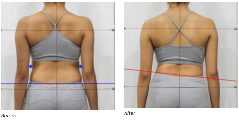 Scoliosis Treatment Before&after