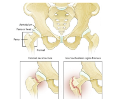 Hip Fractures