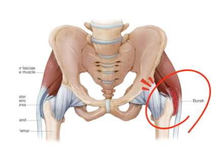 Bursitis