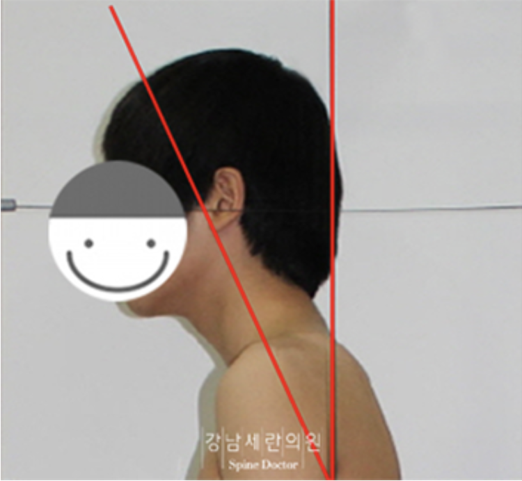 Forward Head Posture