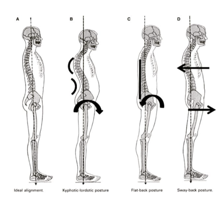 Correcting Spinal Alignment